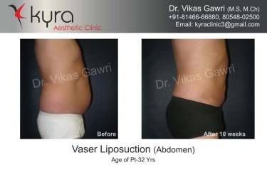LIPOSUCTION MALE