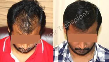 HAIR TRANSPLANT