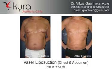 LIPOSUCTION MALE