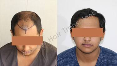 HAIR TRANSPLANT