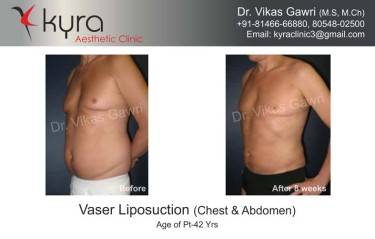 LIPOSUCTION MALE