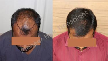HAIR TRANSPLANT