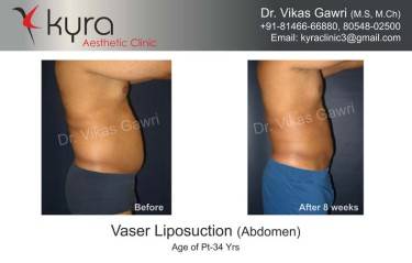 LIPOSUCTION MALE