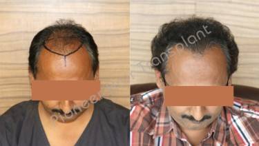 HAIR TRANSPLANT