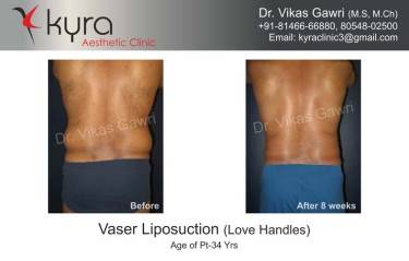 LIPOSUCTION MALE