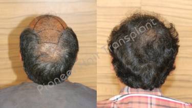 HAIR TRANSPLANT