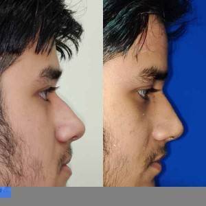 Rhinoplasty