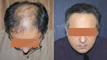 HAIR TRANSPLANT