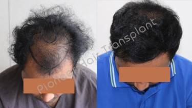 HAIR TRANSPLANT