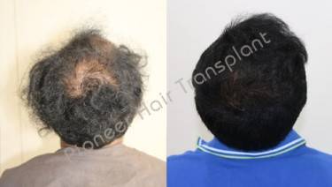 HAIR TRANSPLANT