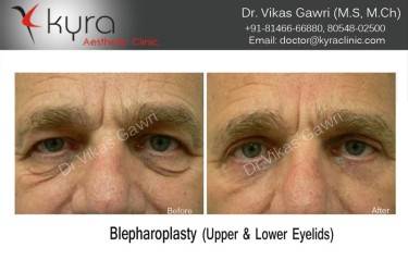 BLEPHAROPLASTY