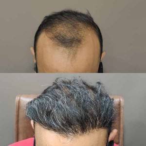 Hair Transplant