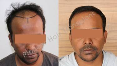 HAIR TRANSPLANT