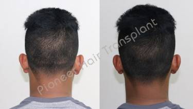 TRYCHOPHYTIC CLOSURE