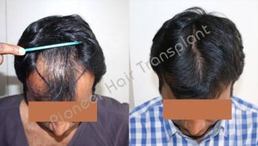 HAIR TRANSPLANT