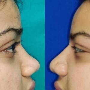 Rhinoplasty