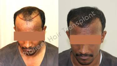 HAIR TRANSPLANT