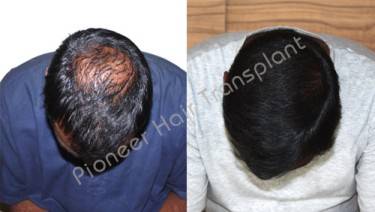 HAIR TRANSPLANT
