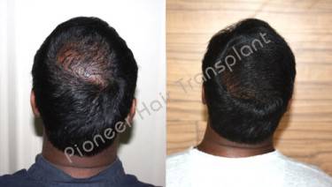HAIR TRANSPLANT