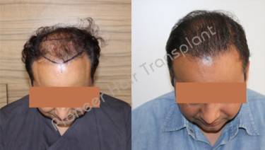 HAIR TRANSPLANT