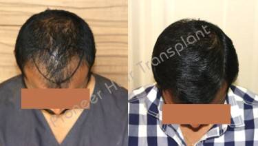 HAIR TRANSPLANT
