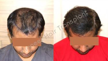 HAIR TRANSPLANT