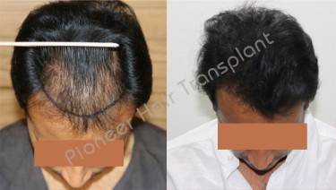 HAIR TRANSPLANT