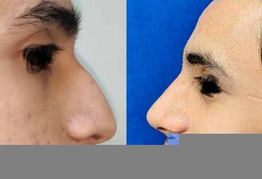 Rhinoplasty