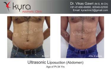 LIPOSUCTION MALE