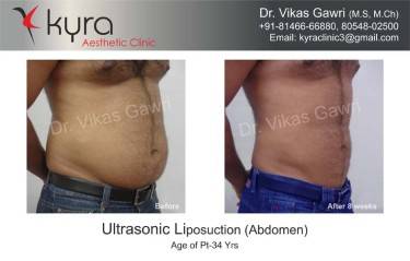 LIPOSUCTION MALE
