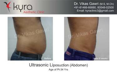LIPOSUCTION MALE
