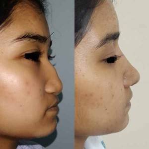 Rhinoplasty