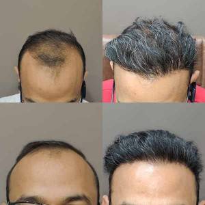 Hair Transplant