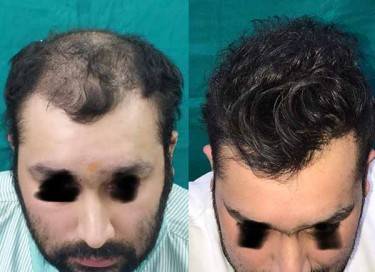 Hair Transplant