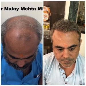 Age55 , Grafts imparted 4500 ,  Grade 6