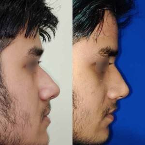 Rhinoplasty