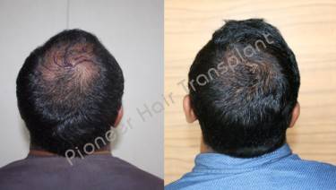 HAIR TRANSPLANT