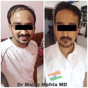 Grafts 4320  , Age 28 years