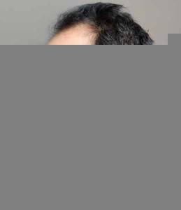 Hair Transplant