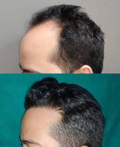 Hair Transplant