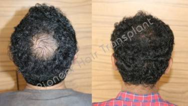 HAIR TRANSPLANT
