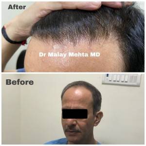 Age 55 , Grafts 4500