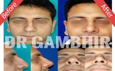 Rhinoplasty