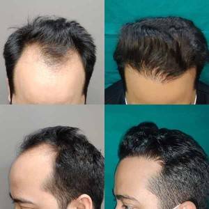 Hair Transplant
