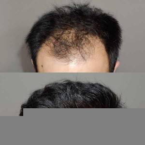 Hair Transplant