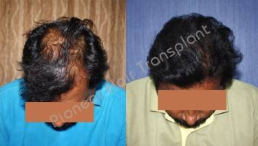 HAIR TRANSPLANT