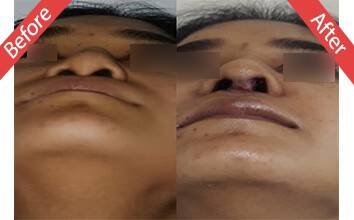 Rhinoplasty