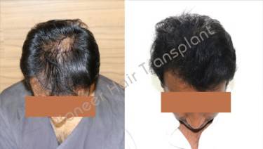 HAIR TRANSPLANT
