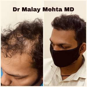 Grade of baldness 3 , Age 30 Years