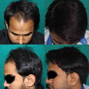 Hair Transplant